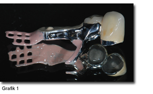 Kombinierter Zahnersatz mit Riegel- oder Geschiebetechnik in Einzelansicht